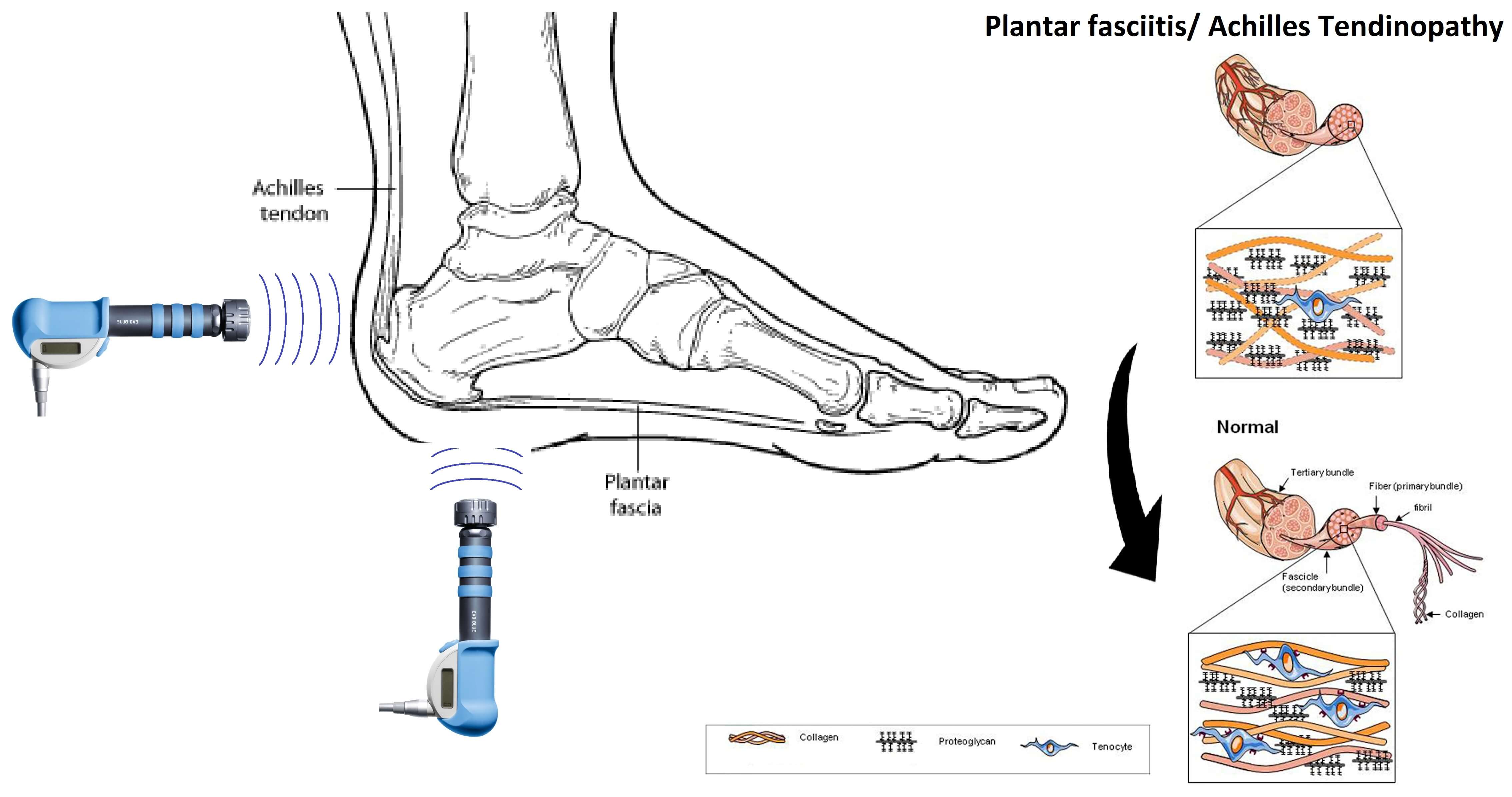 Shockwave Therapy For Shin Splints - Magne-tec