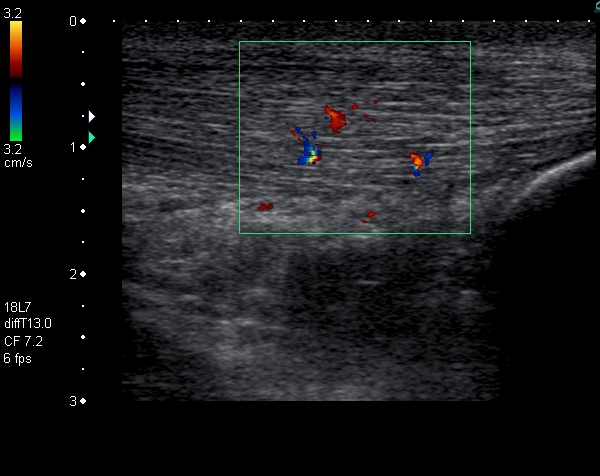 Thick Achilles Tendon Vascular Ultrasound