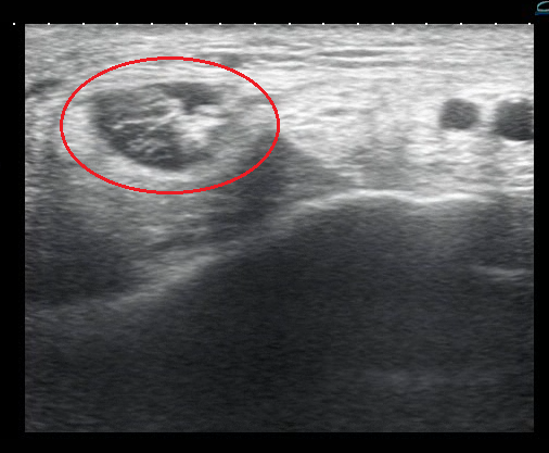 Ultrasound of tibialis posterior tendon