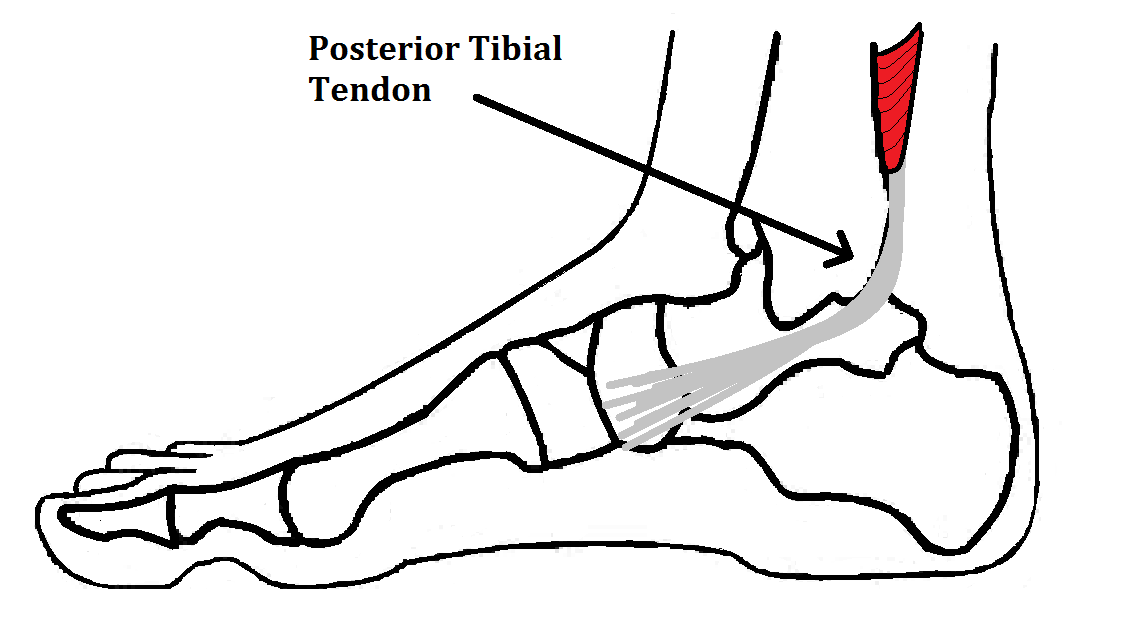 Insertional Tibialis Posterior Tendonitis Ankle Foot And Orthotic Centre