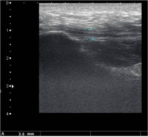 Normal Plantar Fascia