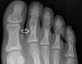 Distal Phalanx Fracture Toe