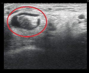 Tibialis posterior tendinopathy ultrasound