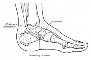 navicular prominence tibialis orthotic tendon