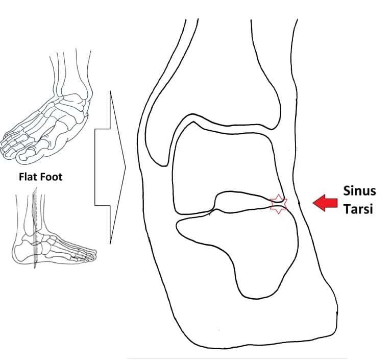 What is Sinus Tarsi Pain? Ankle and Foot Centre