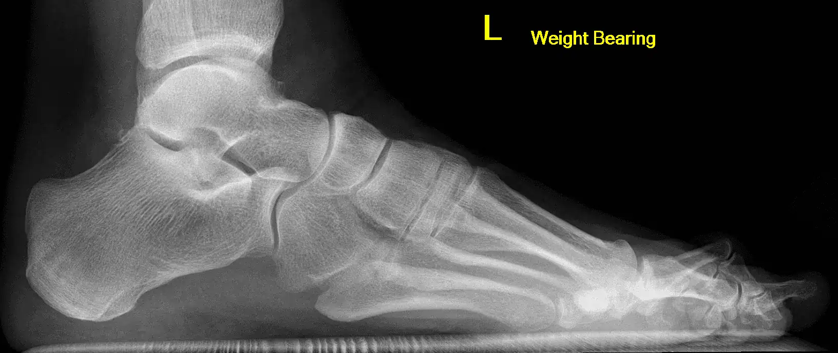 X-ray result of foot in L weight bearing
