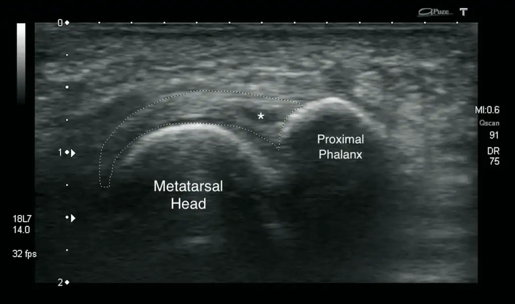 Plantar plate tear ultrasound