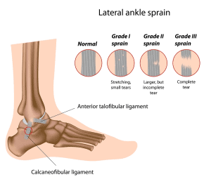 Diagram of lateral ankle sprain