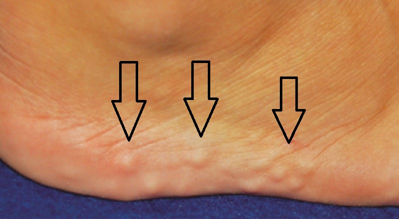 Piezogenic Pedal Papules Ankle Foot And Orthotic Centre