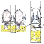 Intermetatarsal bursa & nerve diagram