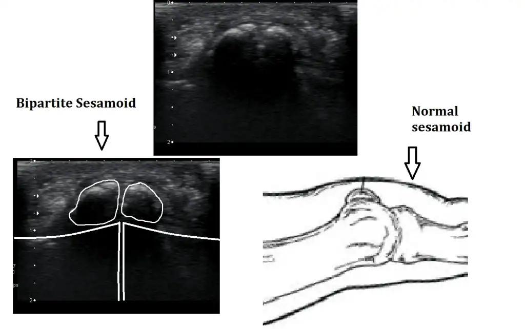 Sesmoid-bipartite