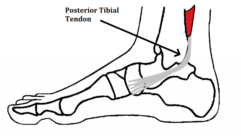 Insertional Tibialis Posterior Tendonitis Ankle Foot And Orthotic Centre 6986