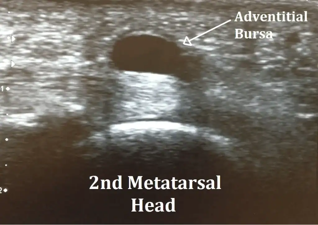 Ultrasound Image Adventitial Bursa