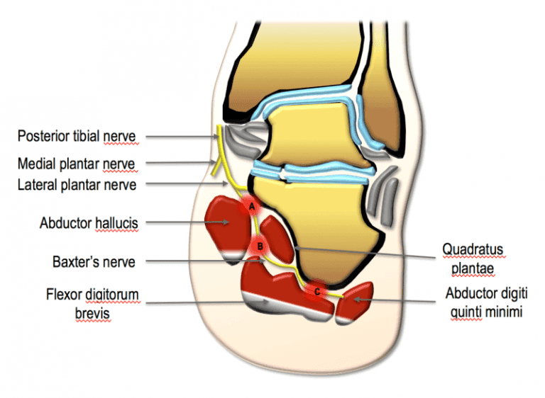 Medial Calcaneal Nerve Entrapment (Baxter’s Neuritis) | AFOC