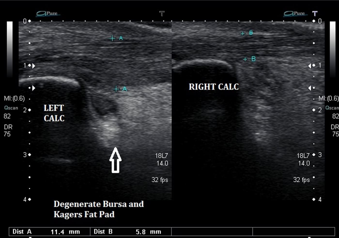 Kager's Fat Pad Irritation Ankle, Foot and Orthotic Centre