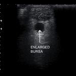 ultrasound of enlarged bursa