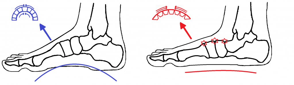 Flat foot dorsal midfoot compression 