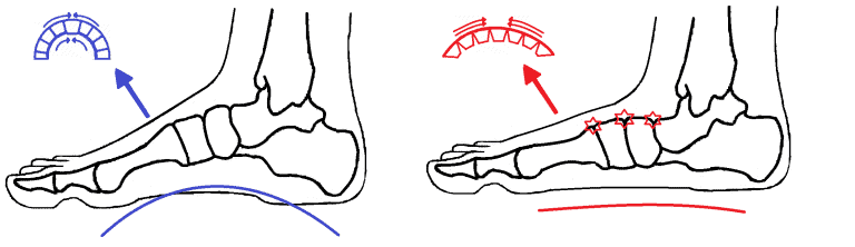 Dorsal Midfoot Compression - Ankle Foot and Orthotic Centre