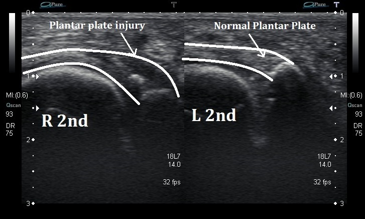 Plantar plate tear ultrasound