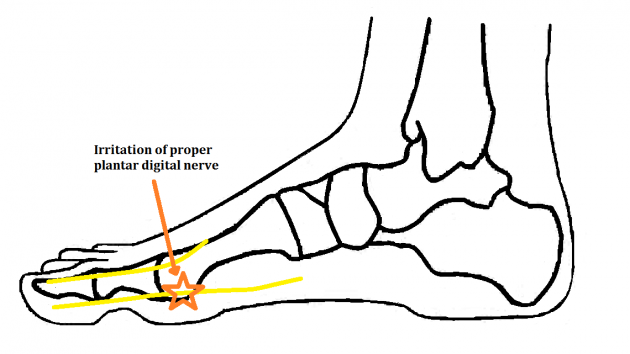 Joplins Neuritis - Ankle, Foot and Orthotic Centre