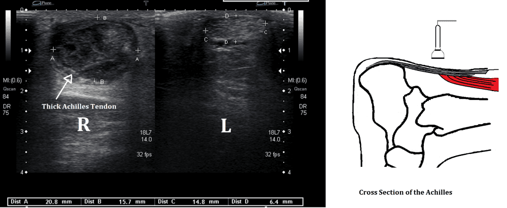 Ultrasound Images Of Achilles Tendinopathy Ankle Foot And Orthotic Ultrasound Images Of Achilles Tendinopathy Ankle Foot And Orthotic