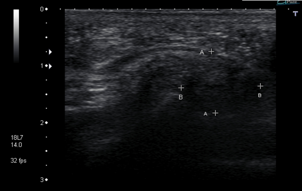Mortons Neuroma Ultrasound