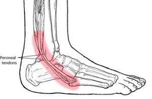 Peroneal Tendinopathy - Ankle, Foot And Orthotic Centre