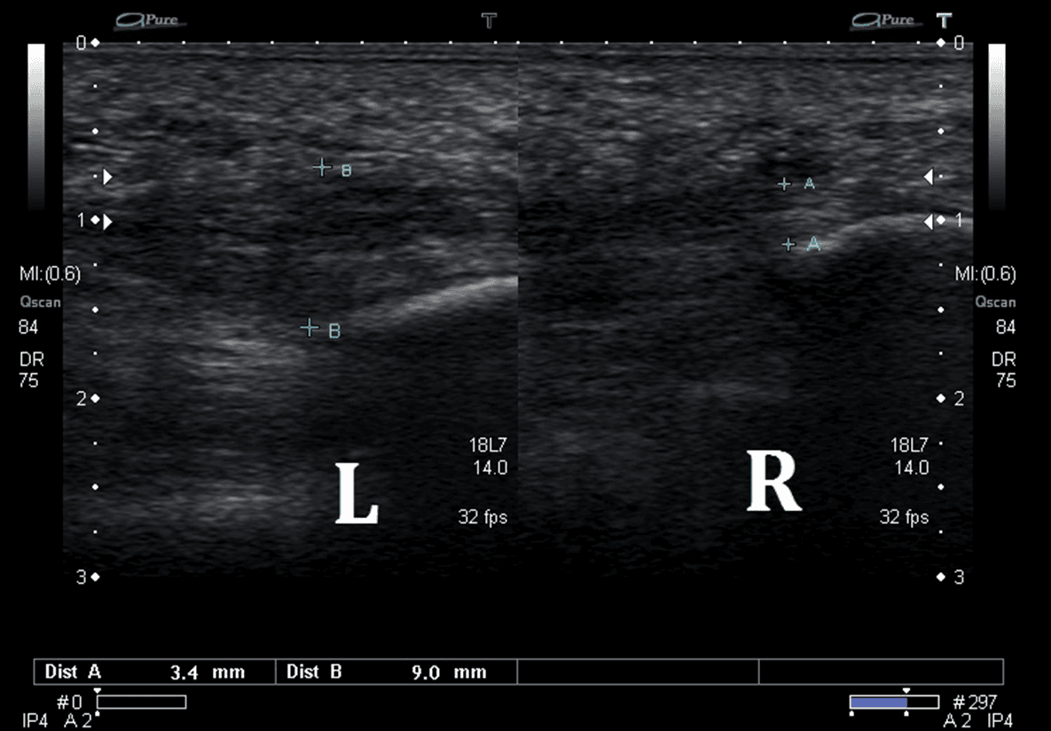 Ultrasound Images of Plantar Fasciitis Ankle, Foot and Orthotic Centre