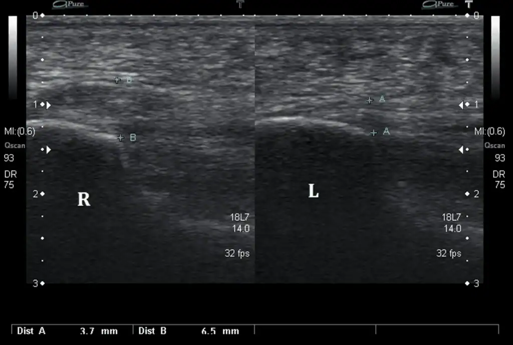 Ultrasound Images of Plantar fasciitis - case 5