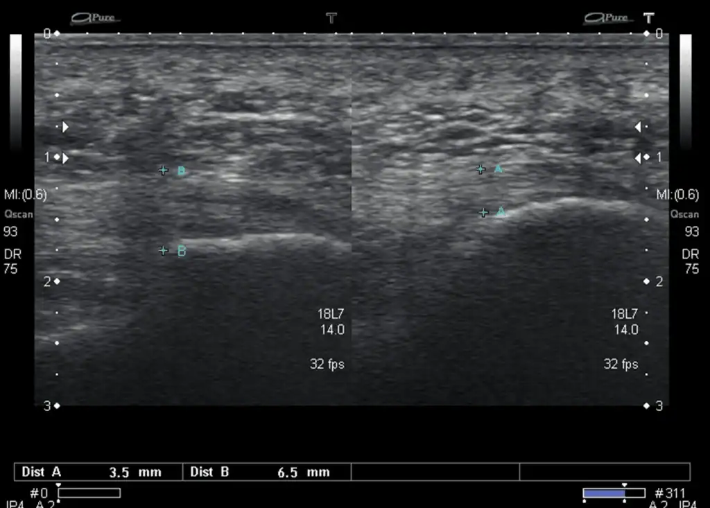 Ultrasound Images of Plantar fasciitis - case 4
