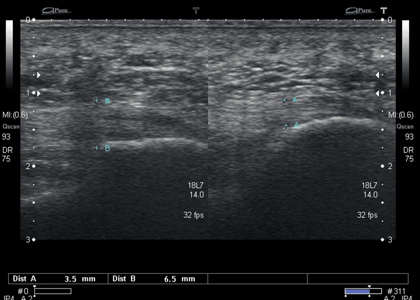 Ultrasound Images of Plantar Fasciitis Ankle, Foot and Orthotic Centre