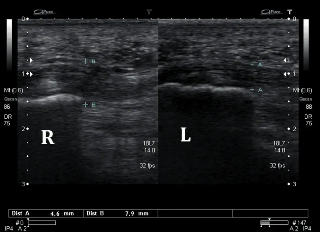 Ultrasound Images of Plantar fasciitis - case 3