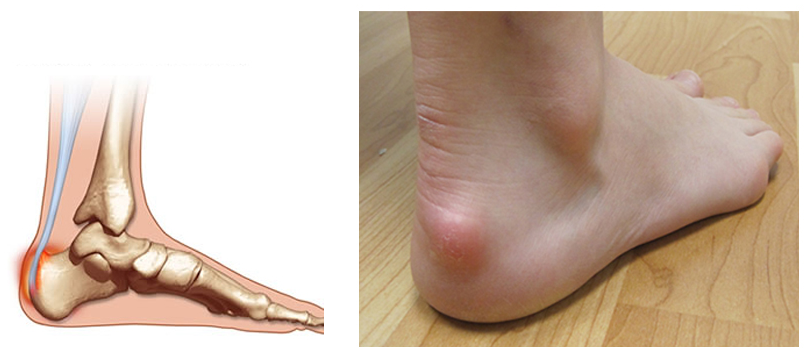 posterior heel bursitis