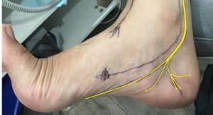 Tibial nerve