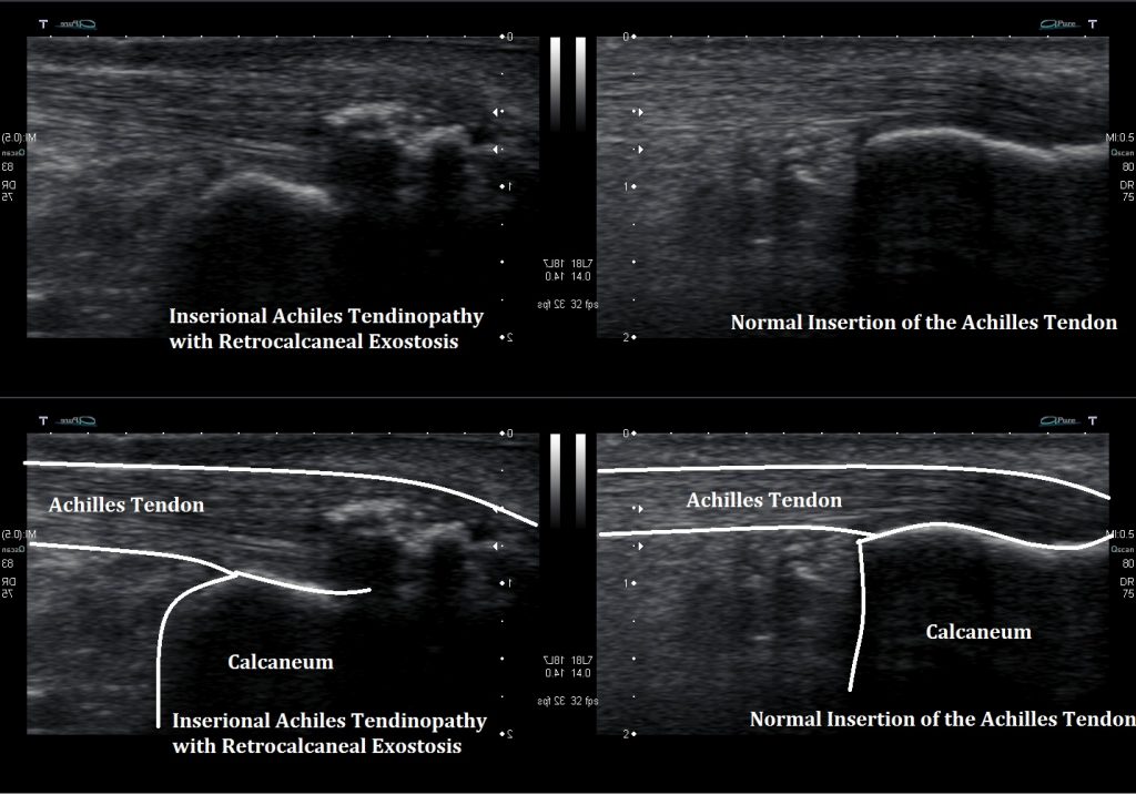 Ultrasound Images of Insertional Achilles Tendinopathy Ankle, Foot