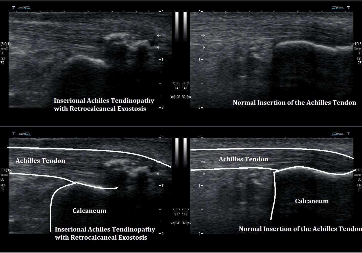 Achilles Tendon Ultrasound Test SJQDGD Achilles Tendon Ultrasound Test SJQDGD