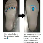 Plantar Plate Pathology