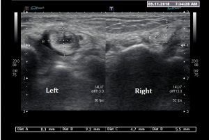 Ultrasound Images of Posterior Tibial Tendon Dysfunction - Ankle, Foot ...