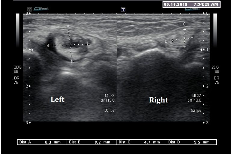 Ultrasound Posterior Tibial My XXX Hot Girl