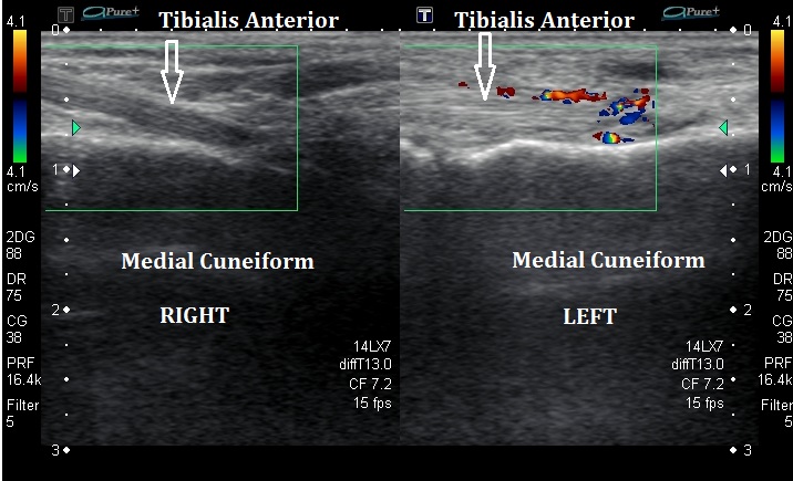 Tibialis Anterior insertional Ultrasound