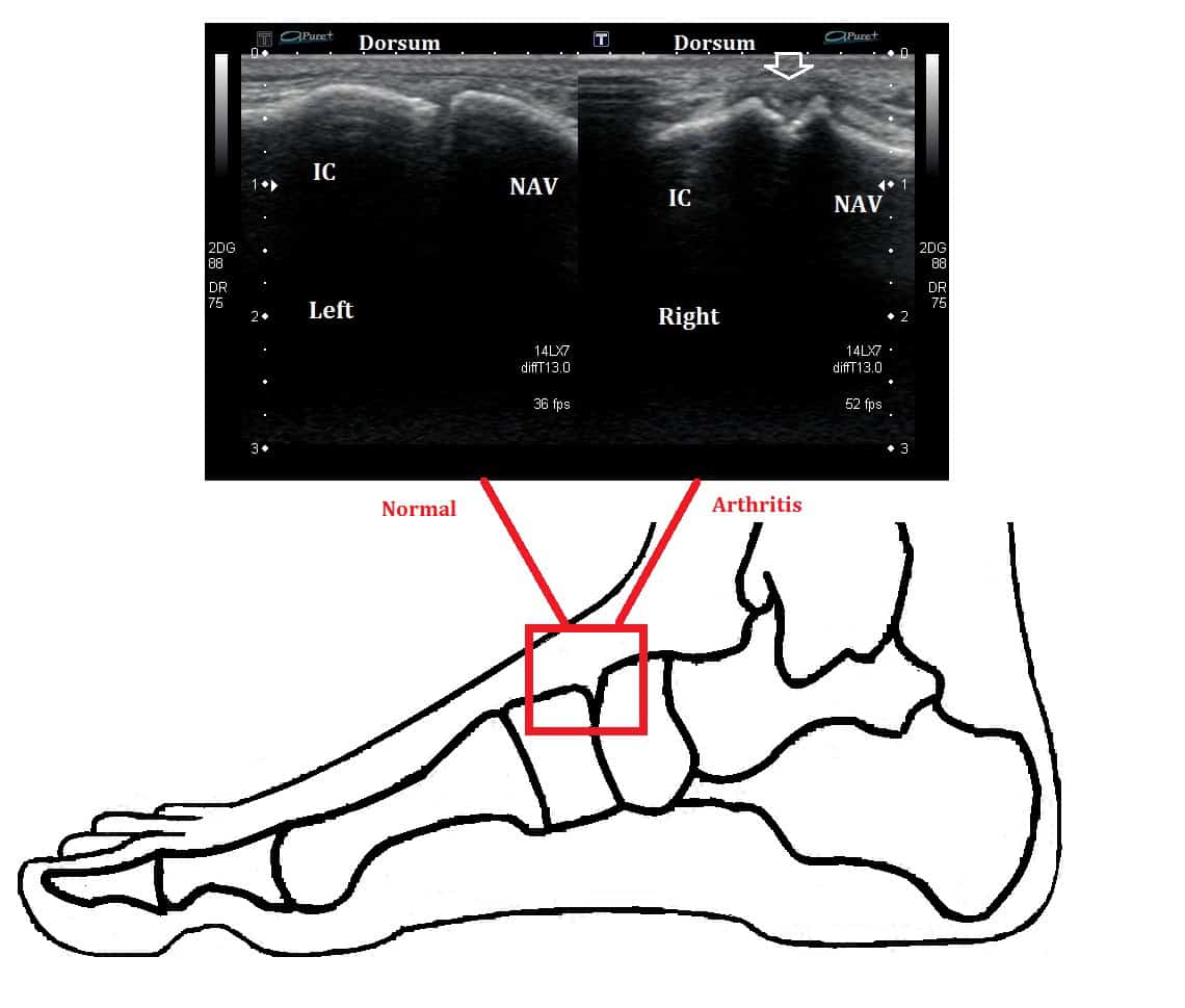 Midfoot Arthritis Ankle, Foot and Orthotic Centre