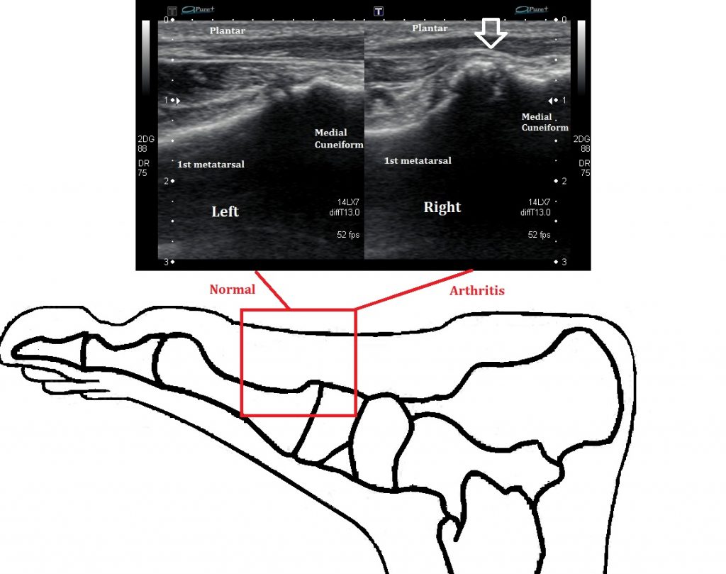 Midfoot Arthritis Ultrasound