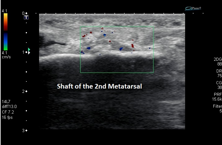 Ultrasound stress fracture