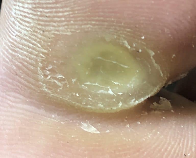 Smokers / Fibrous / Neurovascular corns (intractable plantar