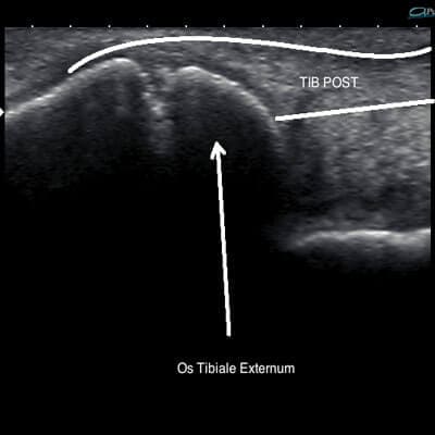 Accessory Navicular Syndrome