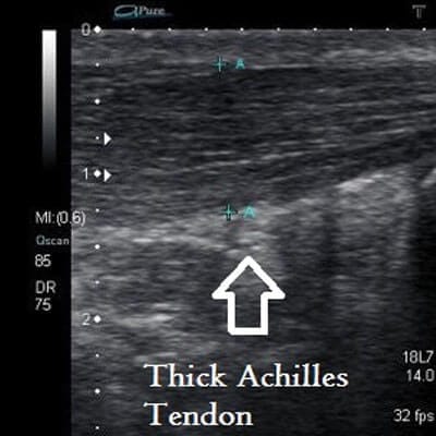 Midportion Achilles Tendinopathy
