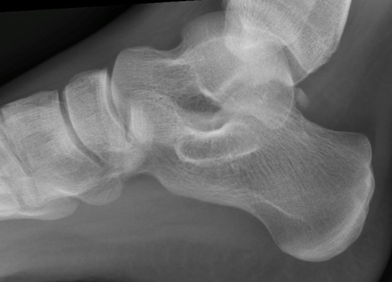 Adult foot before