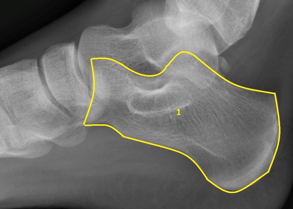 Xray of a Adults Foot