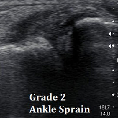 Ankle Sprain