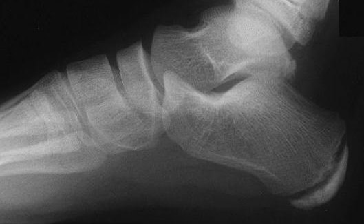Child foot X-ray Apophysis